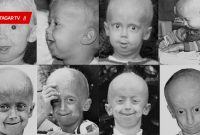 Penyakit Langka Yang Belum Banyak Dikenal