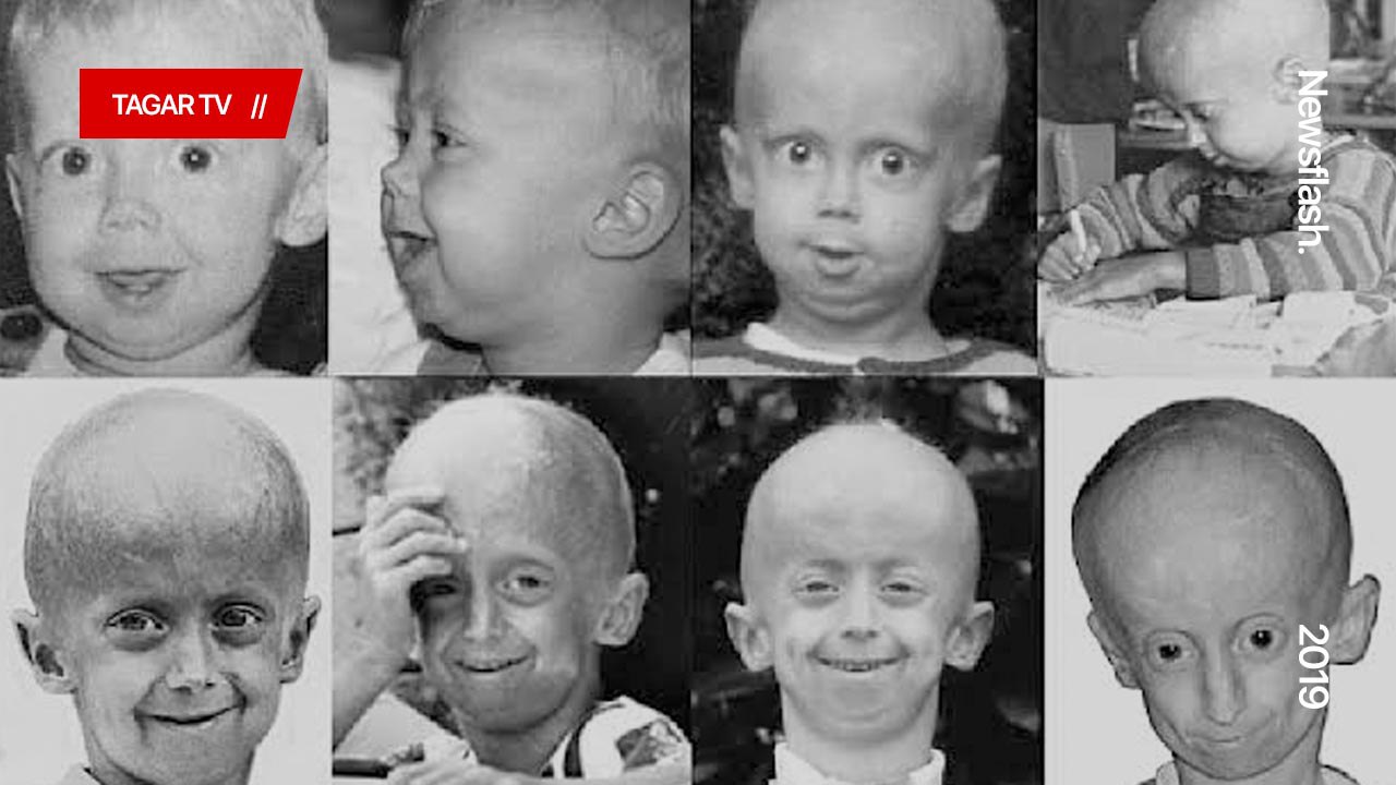 Penyakit Langka Yang Belum Banyak Dikenal